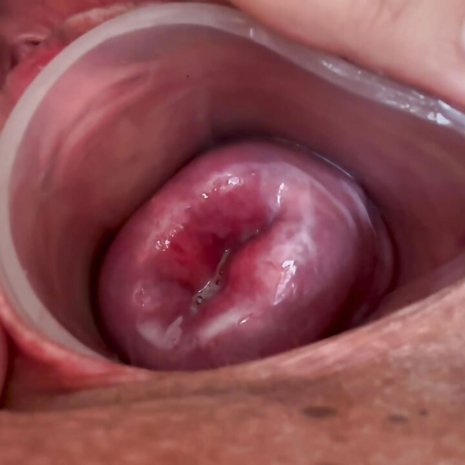 Scrolldrop cervix